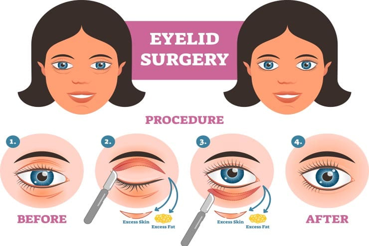 Eyelid Surgery