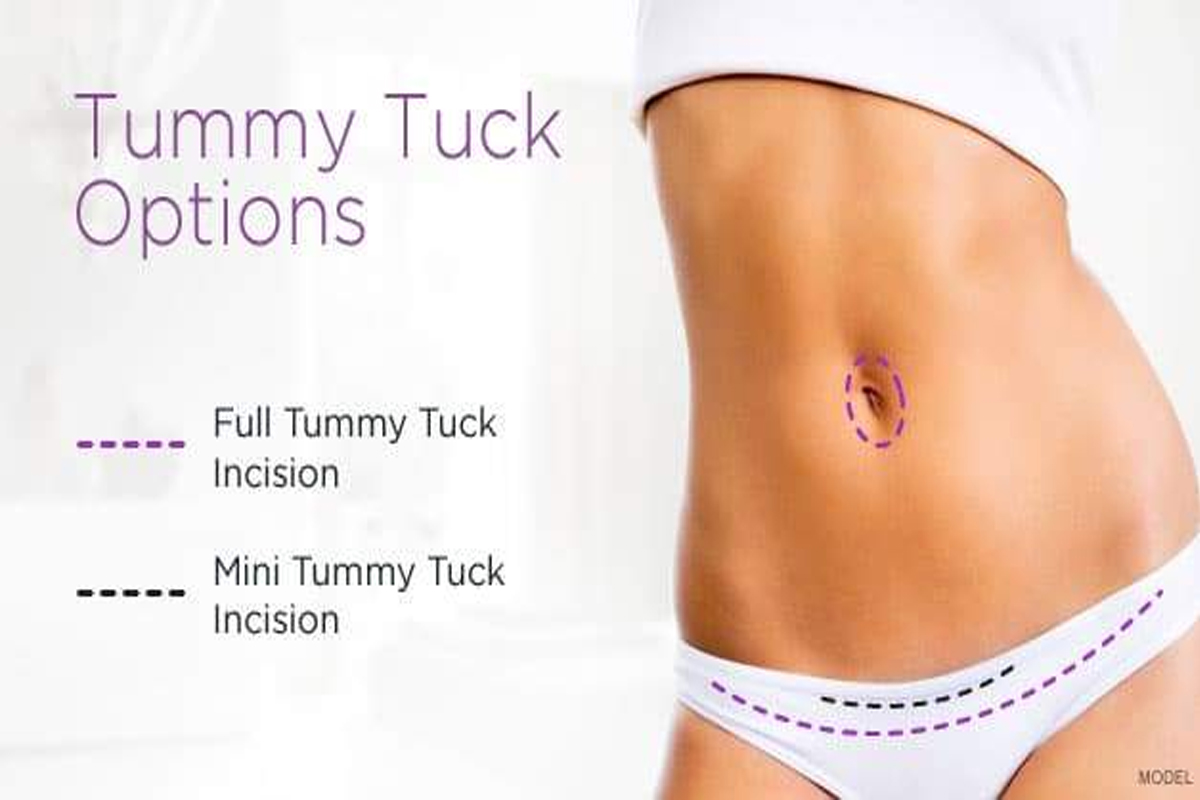 Tummy Tuck Surgery