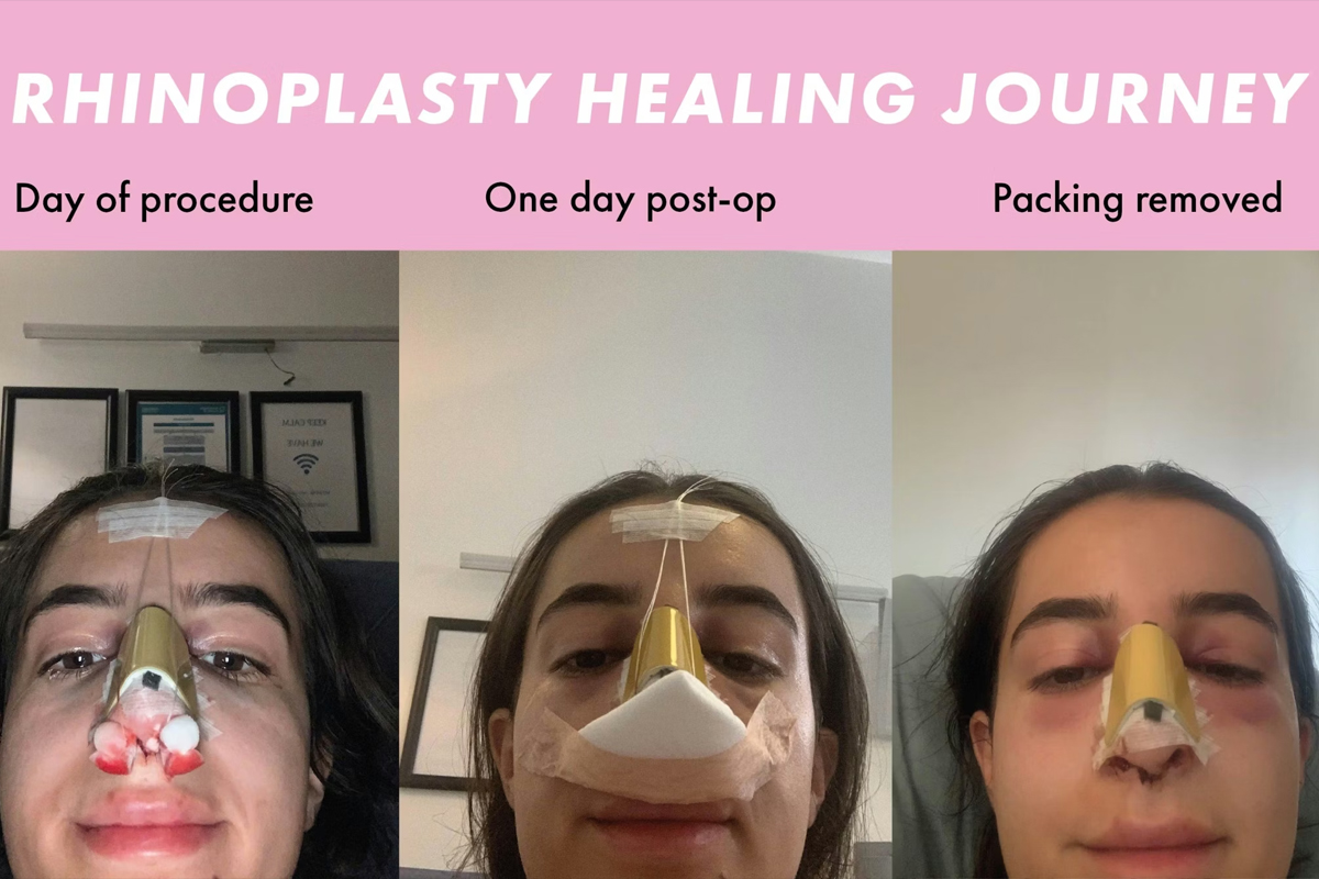 Rhinoplasty